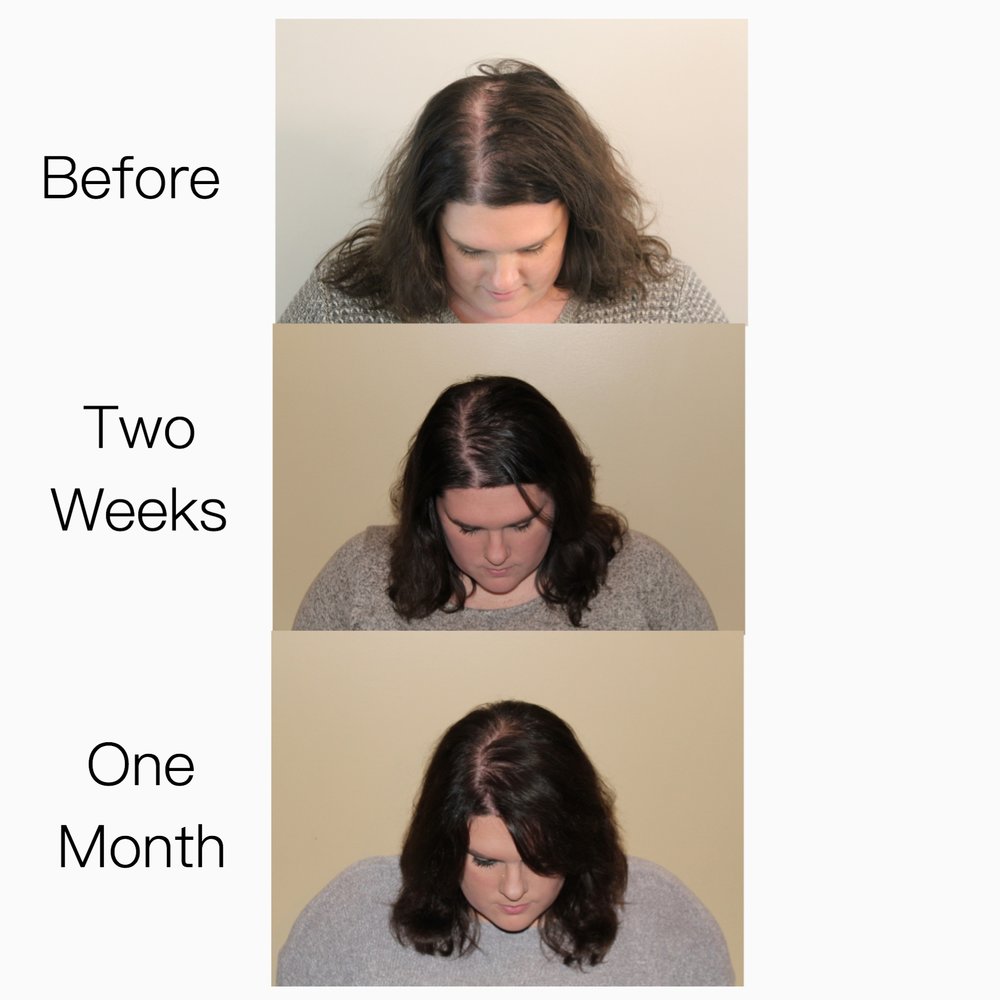 Before, Two Weeks, and One Month progress of hair growth on a person with a beige background.